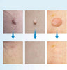Dermaswift – Hautfleckenentferner Gegen Warzen Und Haut Anhänger